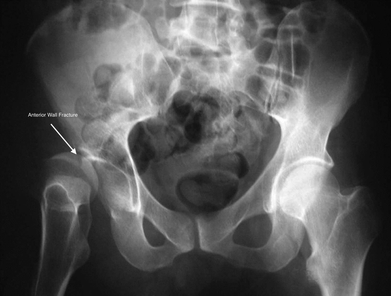 Acetabular Fractures