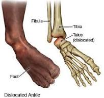 Ankle Dislocation