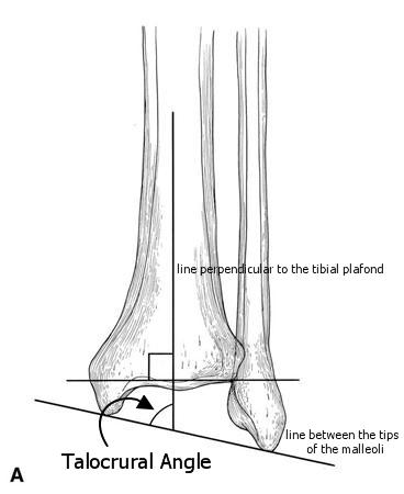 Ankle Fractures