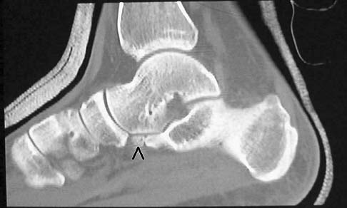 Calcaneus Fractures