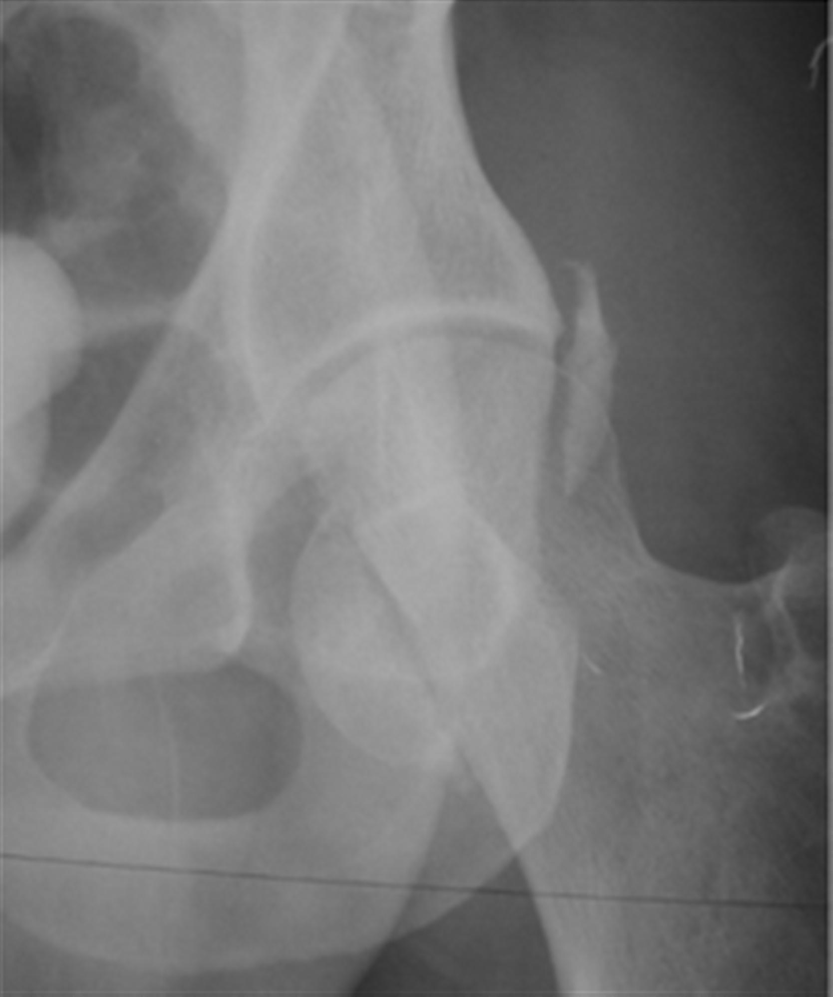 Femoral Head Fractures