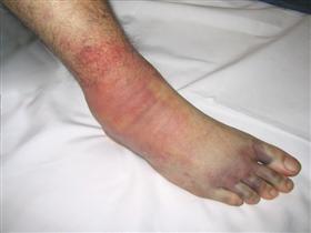 Foot Compartment Syndrome