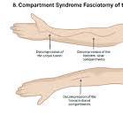 Hand & Forearm Compartment Syndrome