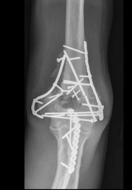 Distal Humerus Fractures