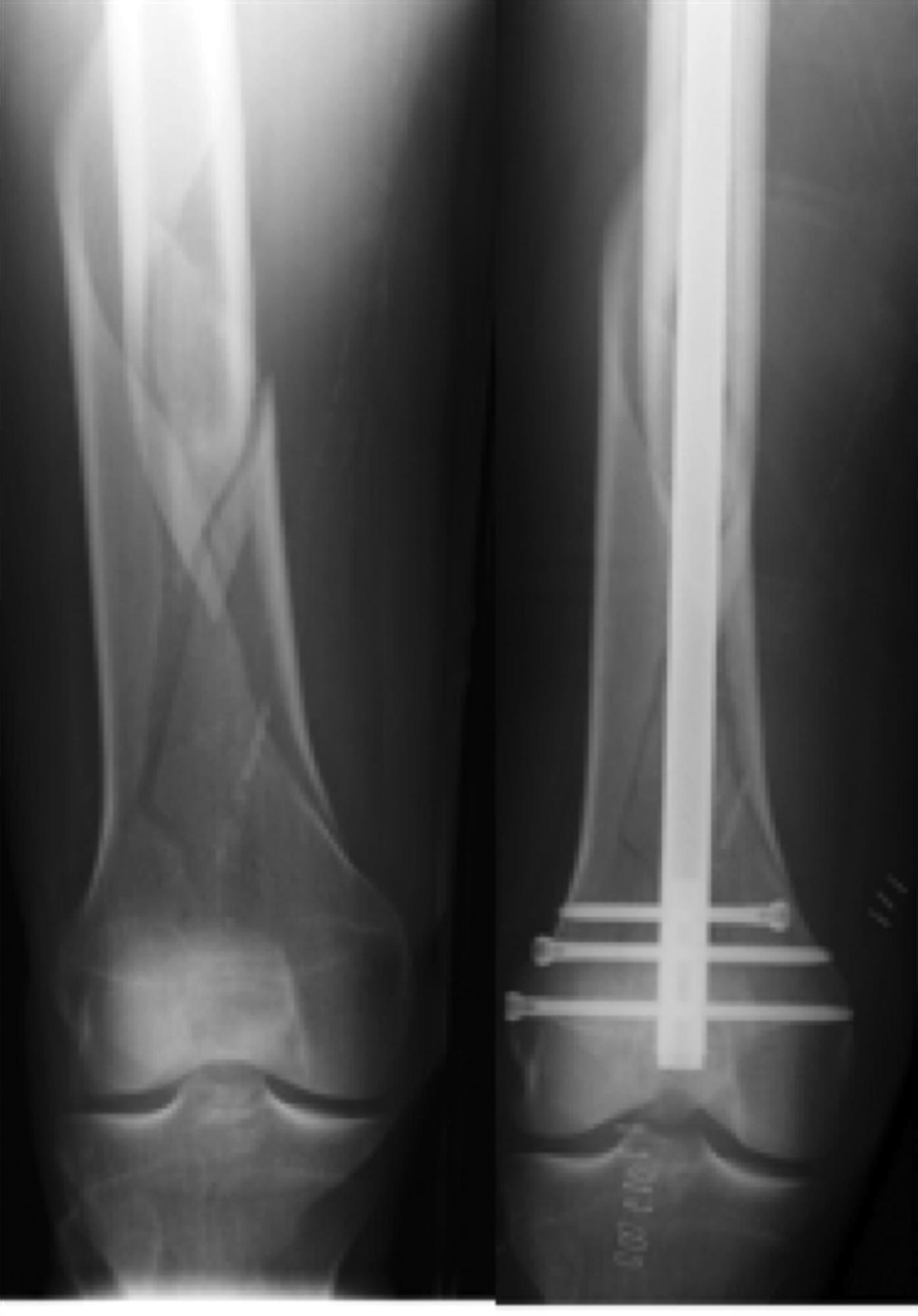 Femoral Shaft Fractures