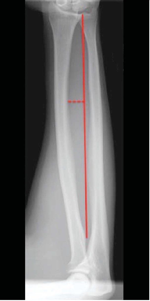 Radius and Ulnar Shaft Fractures