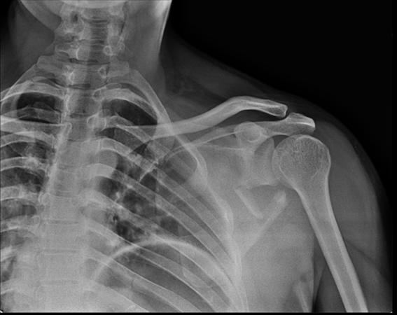 Scapula Fractures