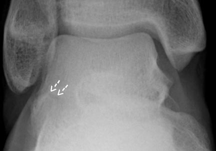 Talus Fracture (other than neck)