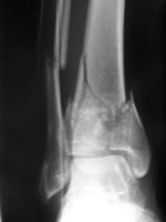 Tibial Plafond Fractures